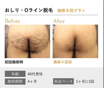 メンズ脱毛サロン専門店RINX/メンズ脱毛/RINX/リンクス/スキンケア/脱毛サロン/美容男子/美意識/清潔/沖縄/北谷/那覇