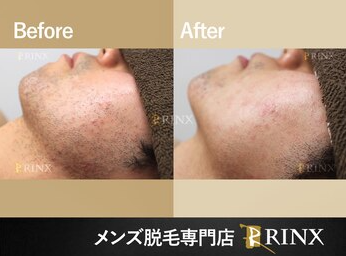 メンズ美容/メンズ脱毛/メンズエステ/北谷エステ